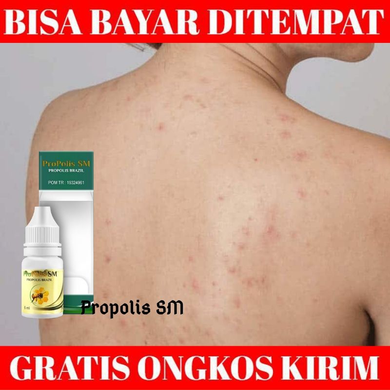 Obat Biang Keringat Gatal Gatal Miliaria Rubra Bintik Bintik Di Badan Gatal Biang Keringat Obat Biang Keringat Anak dan Dewasa Dengan Propolis SM Obat Biang Keringat Gatal Gatal Miliaria Rubra Bintik Bintik Di Badan Gatal Biang Keringat Obat Biang Keringat Anak dan Dewasa Dengan Propolis SM