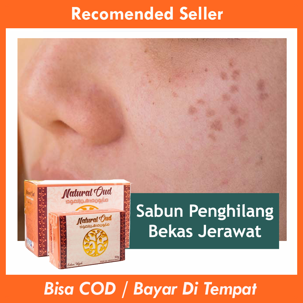 Sabun Penghilang Bekas Jerawat Dan Bopeng Obat Penghilang Bekas Jerawat Hitam Obat Memudarkan Bekas Jerawat Sabun Penghilang Bekas Jerawat Pria Sabun Penghilang Bekas Jerawat Wanita - Sabun Natural Oud Original Sabun Penghilang Bekas Jerawat Dan Bopeng Obat Penghilang Bekas Jerawat Hitam Obat Memudarkan Bekas Jerawat Sabun Penghilang Bekas Jerawat Pria Sabun Penghilang Bekas Jerawat Wanita - Sabun Natural Oud Original