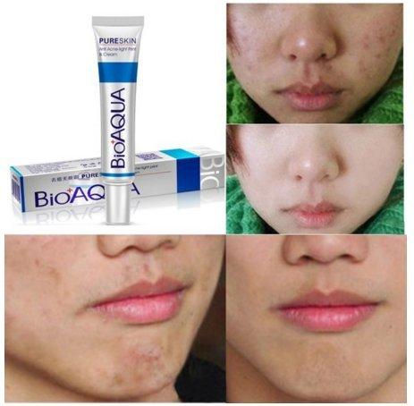 Bioaqua Anti Acne Anti Jerawat Removal Of Acne Januari 2019 - 4 Bioaqua Anti Acne Anti Jerawat Removal of Acne - 4