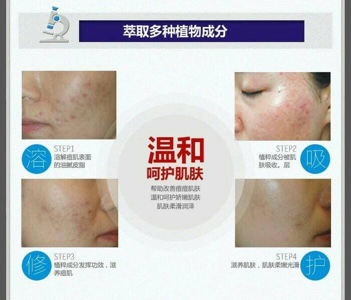 Bioaqua Anti Acne Anti Jerawat Removal Of Acne Januari 2019 - 3 Bioaqua Anti Acne Anti Jerawat Removal of Acne - 3